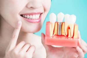 Oral Rehabilitation with Dental Implants