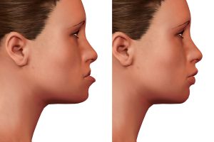 What Are the Benefits of Orthognathic Surgery?